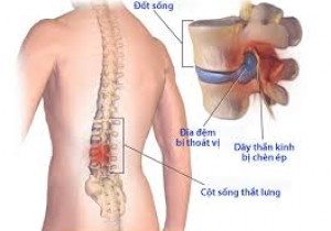 Thông báo chào giá các mặt hàng thiết bị y tế sử dụng trong phẫu thuật cột sống lưng năm 2025-2026 tại Bệnh viện Đa khoa khu vực miền núi phía Bắc Quảng Nam
